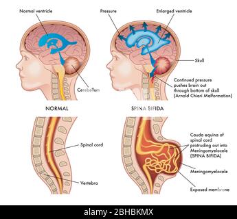 Medizinische Illustration zeigt ein Kind in zwei Situationen, links gesund und rechts von Spina bifida mit Anmerkungen, die die Symptome der befallen Stock Vektor