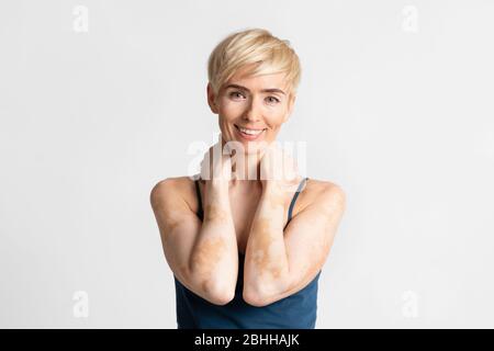 Porträt einer Frau mit Vitiligo, kein Make-up Stockfoto