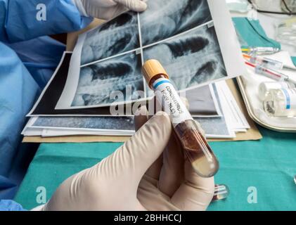 Wissenschaftler vergleicht Röntgenaufnahmen mit einer Ampulle Blut von SARS-Cov-2 von einem infizierten Patienten, konzeptionelle Bild Stockfoto