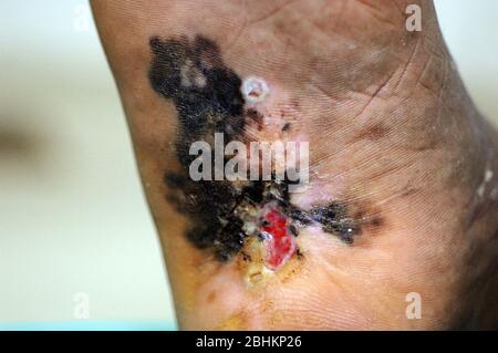Nahaufnahme eines malignen Melanoms an der Ferse einer älteren Frau. Melanom ist ein bösartiger Tumor von Melanozyten (Pigment produzierende Zellen) in der gefunden Stockfoto
