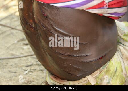 Die rohen Narben auf dem Rücken einer Hamar-Frau, nachdem sie bei einer Zeremonie zum "Springen des Stiers" gepeitscht wurde. Fotografiert im Omo River Valley, Äthiopien Stockfoto