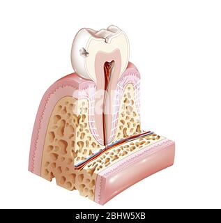 Erste Stufe Zahnkaries, erreichen den Zahnschmelz. Der Zahnschmelz ist die oberflächlichste Schicht der Zahnkrone. Wir können in dieser Zeichnung zwei Kav sehen Stockfoto