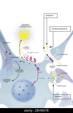 Mit neurofibrilläre Degeneration Prozess Neuron, senile Plaques, Behandlungen. Neuron im zentralen Nervensystem durch abnorme Spaltung von APP betroffen Stockfoto