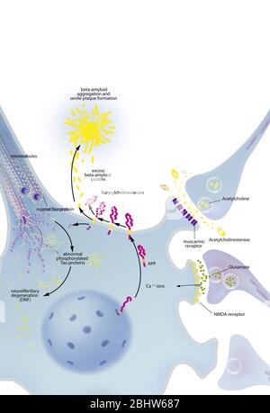 Mit neurofibrilläre Degeneration Prozess Neuron, senile Plaques, Behandlungen. Neuron im zentralen Nervensystem durch abnorme Spaltung von APP betroffen Stockfoto