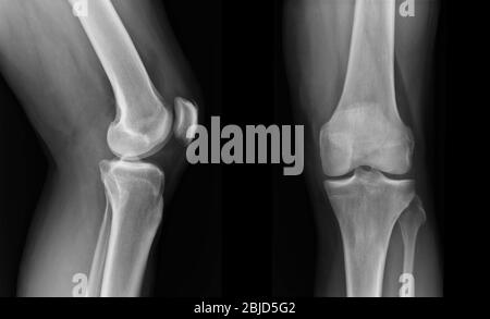 Röntgenaufnahmen des Kniegelenks zeigen den Verletzungszustand Stockfoto