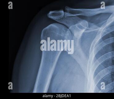 Röntgenaufnahmen der Schulter zeigen den Verletzungszustand Stockfoto