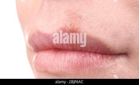 Herpes Blasen auf weiblichen Lippen Nahaufnahme Stockfoto