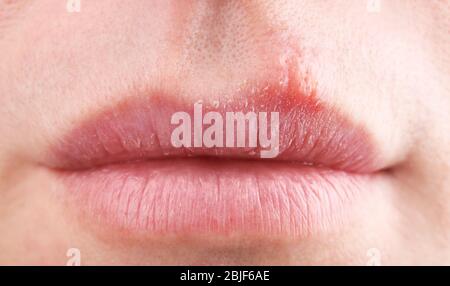 Herpes Blasen auf weiblichen Lippen Nahaufnahme Stockfoto