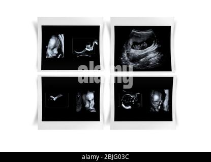 Ultraschall Bilder von Baby auf weißem Hintergrund Stockfoto