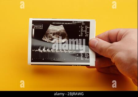 Überprüfung des zukünftigen Herzschlags des Babys per Ultraschalluntersuchung Stockfoto