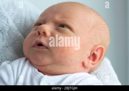 Porträt eines Neugeborenen mit Erscheinungsformen einer Allergie im Gesicht Stockfoto