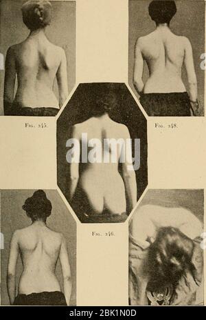 "Atlas Manuel de Gymnastique Orthopédique: Traitement des Déviations De La Taille; 51 Planches Comprenant 209 Figuren, et 53 Figuren Dans le Texte "(1903) Stockfoto