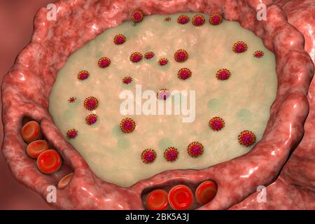 Menschliche Alveolen gefüllt mit Flüssigkeit und SARS-CoV-2-Viren während COVID-19-Infektion, konzeptionelle Computerdarstellung. Stockfoto