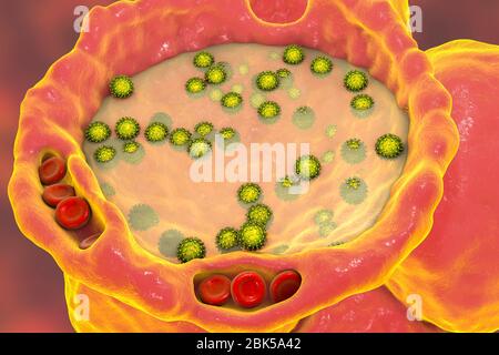 Menschliche Alveolen gefüllt mit Flüssigkeit und SARS-CoV-2-Viren während COVID-19-Infektion, konzeptionelle Computerdarstellung. Stockfoto