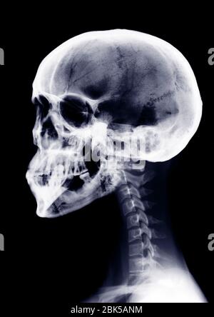 Menschlicher Schädel und Hals, Röntgenstrahlung. Stockfoto