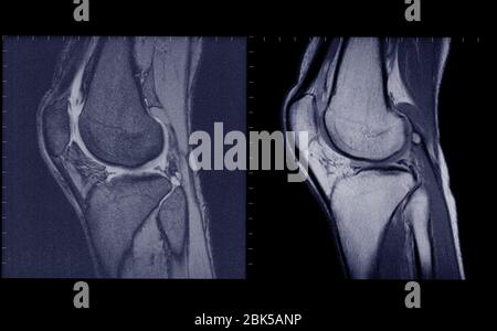 Kniegelenke Seitenansicht, MRT. Stockfoto