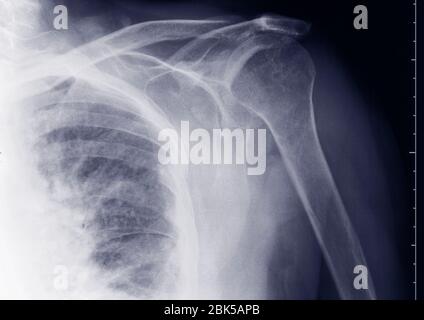 Schulter, Röntgenstrahlung. Stockfoto