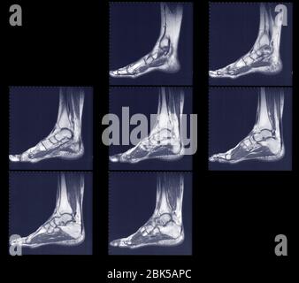 Scans der Füße und Knöchel Seite, MRT. Stockfoto