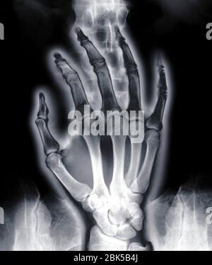 Menschliche Hand über Wirbelsäule, Röntgen. Stockfoto
