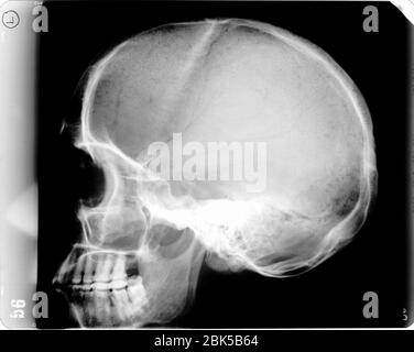 Menschlicher Schädel mit Glühbirne, Röntgen. Stockfoto