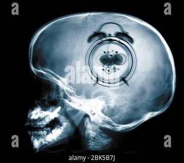 Menschlicher Schädel und Uhr, Röntgenstrahlung. Stockfoto