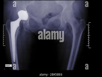 Person mit künstlicher Hüfte, Röntgen. Stockfoto