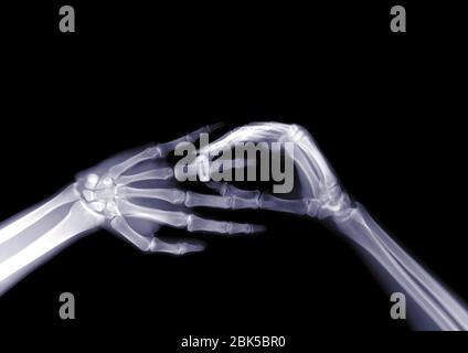 Ehering wird auf den Finger einer Person gelegt, Röntgenstrahlen. Stockfoto