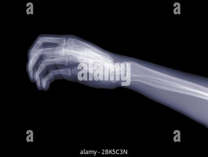 Hand und Arm von der Seite, Röntgen. Stockfoto