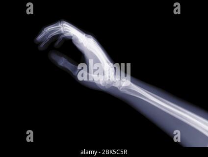 Hand und Arm von der Seite, Röntgen. Stockfoto