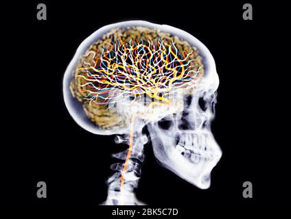 Schädel mit Gehirn und Neuronen, farbiger Röntgenstrahl. Stockfoto