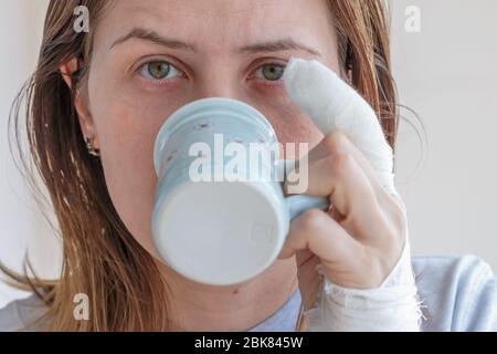 Eine junge Frau, die Kaffee trinkt und mit einem verletzten verbandten Finger eine kleine blaue Tasse in der linken Hand hält Stockfoto