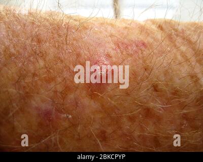 Hautkrebs ist in dieser Ansicht von oben auf ein Plattenepithelkarzinom am haarigen Arm eines kaukasischen Mannes offensichtlich. Am häufigsten durch jahrelange Exposition gegenüber der Sonne ultravioletten (UV) Strahlen verursacht, ist es eine der häufigsten Arten von Hautkrebs. Die Behandlung für solche harten Klumpen mit schuppigen Spitzen ist in der Regel chirurgische Entfernung durch einen Dermatologen. Vermeiden Sie längere Exposition gegenüber ultravioletter Strahlung und die Verwendung von Sonnenschutzmittel sind empfohlene Möglichkeiten, um Hautkrebs zu verhindern. Stockfoto