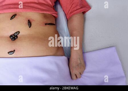 Blutsaugende Leechs hirudo medicinalis auf dem Bauch der Frau in einem rosa T-Shirt. Ansicht von oben Stockfoto