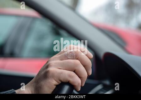 Brennender Schmerz. Wunde von Brandarbeit Unfall auf der Hand des Mannes, fahren in den Notfall Stockfoto