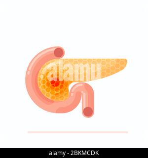 Abbildung zeigt kranke menschliche Bauchspeicheldrüse, Konzept der menschlichen Pankreatitis und Krebs, flaches Design Vektor Illustration Stock Vektor