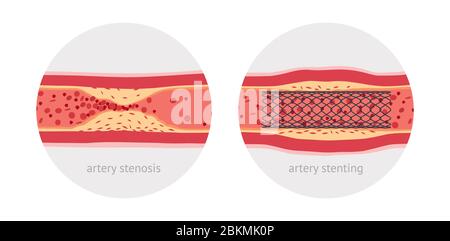 Stentende kranke menschliche Arterie, vor und nach, flache Design-Illustration Stock Vektor