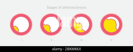 Arteriosklerose Stadien in der Arterie durch Cholesterin Plaque verursacht Stock Vektor