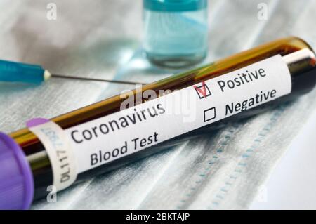 Blutprobenschlauch positiv mit COVID-19 oder neuartigem Coronavirus SARS-CoV-2. Stockfoto