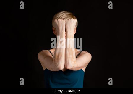 Psychologische Selbstverteidigung. Mädchen mit Vitiligo versteckt ihr Gesicht. Stockfoto