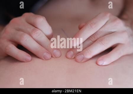 Ärzte Hand führen medizinische professionelle Akupunktur-Behandlung im Beauty-Spa auf mans Körper.Akupunktur, Akupressur mit Nadeln. Nadeln auf einem Mann s b Stockfoto