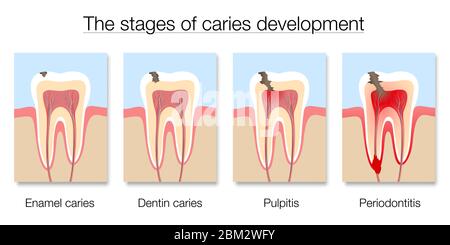 Karies-Stufendiagramm, Entwicklung von Karies mit Zahnschmelz und Dentin Karies, Pulpitis und Parodontitis - Abbildung auf weißem Hintergrund. Stockfoto