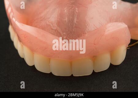 Zahnprothese aus Acryl mit Metallhalteelementen auf schwarzem Hintergrund Stockfoto