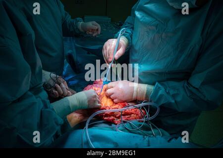 Ein chirurgisches Team führt eine chirurgische Bauchoperation durch Stockfoto