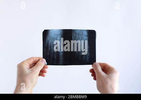 Die Hände eines Arztes halten Film-Röntgen beide Füße. Fußfinger auf Röntgenaufnahmen, MRT der Fußfinger Stockfoto