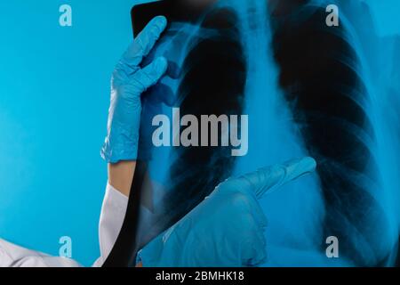 Der Arzt hat einen Verdacht auf eine Lungenröntgenaufnahme gefunden. Stockfoto