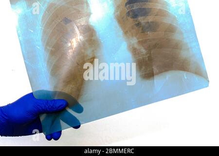 Hand in blauem Gummi schützende medizinische chirurgische Handschuh hält Röntgenaufnahmen der menschlichen Lunge Stockfoto