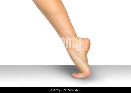 Elhers danlos. Eine genetische Störung Bindegewebe. Stockfoto