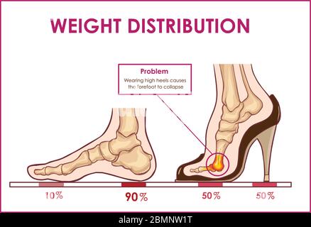 Vektordarstellung von Fußschmerzen und Gewichtsverteilung durch das Tragen von High Heels Stock Vektor