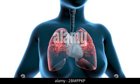 Computerdarstellung, die die Lungen einer mit Viruspartikeln infizierten Frau zeigt. Stockfoto