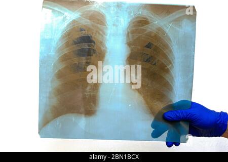Hand in blauem Gummi schützende medizinische chirurgische Handschuh hält Röntgenaufnahmen der menschlichen Lunge Stockfoto